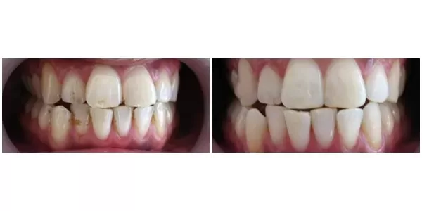 Dişlerinizde ki Sigara Ve Çay Lekelerinden Kurtulabilirsiniz. %100 Çözüm